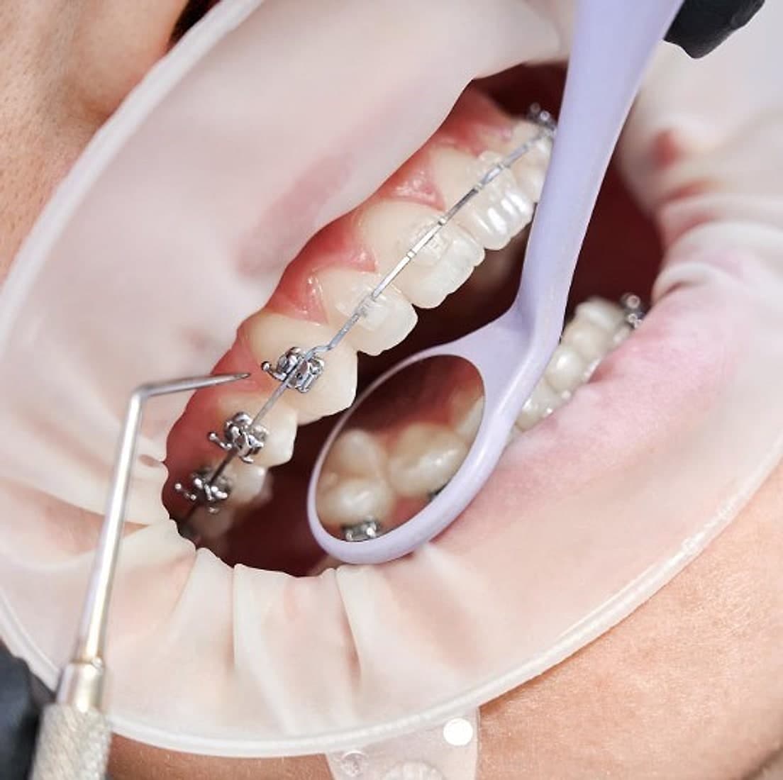 Tratamiento de ortodoncia con brackets metálicos durante un control clínico